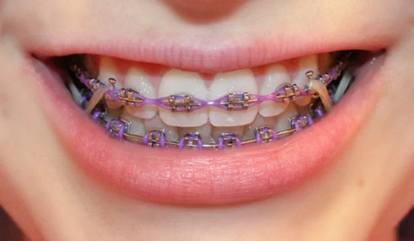 أفضل دكتور تقويم أسنان في مصر, تقويم الأسنان في القاهرة, أسعار تقويم الأسنان في مصر, دكتور تقويم شفاف, تكلفة تقويم الأسنان الشفاف, عيادة تقويم أسنان مصر, أفضل دكتور أسنان أطفال, دكتور تقويم أسنان بالتقسيط, تجارب تقويم الأسنان في مصر, أفضل طبيب أسنان في القاهرة, أنواع تقويم الأسنان, تقويم الأسنان المعدني, تقويم الأسنان الشفاف, أسعار تقويم الأسنان 2025, دكتور تقويم مشهور, دكتور تقويم أسنان في المهندسين, تقويم أسنان سريع, تقويم الأسنان بدون ألم, تقويم الأسنان للمراهقين, تقويم الأسنان للكبار, دكتور أسنان تقويم في مصر الجديدة, تكلفة تقويم الأسنان في الإسكندرية, عيادة تقويم في الجيزة, مدة تقويم الأسنان, دكتور أسنان تقويم متخصص, استشارة تقويم أسنان مجانية, أفضل مركز تقويم أسنان, عيادة أسنان شاملة في مصر, علاج بروز الفك بالتقويم, تقويم الأسنان التجميلي