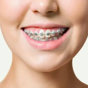 جهاز توسيع الفك للأطفال، فوائد تقويم الأسنان للمراهقين، تقويم الأسنان المعدني، السن المناسب لتقويم الأسنان، تقويم الأسنان الوقائي، تقويم الأسنان الثابت للأطفال، أعراض تحتاج لتقويم الأسنان، علاج تزاحم الأسنان، نصائح بعد تركيب التقويم، العناية بتقويم الأطفال، مشاكل التقويم عند المراهقين، نتائج تقويم الأسنان قبل وبعد، تقويم الأسنان بالتقسيط في مصر، تقويم الأسنان للأسنان اللبنية