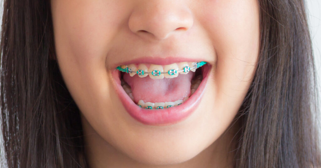 تقويم أسنان الأطفال, مركز تقويم أسنان, علاج تقويم أسنان الأطفال, تقويم أسنان للأطفال, أفضل دكتور تقويم أسنان للأطفال, تقويم الأسنان للأطفال في بنها, تقويم الأسنان للأطفال في مصر, تقويم أسنان الأطفال بأسعار مناسبة, تقويم أسنان للأطفال في القاهرة, أفضل مركز لتقويم الأسنان للأطفال, تقويم أسنان للأطفال بدون ألم, تقويم أسنان للأطفال بأحدث التقنيات, علاج تقويم الأسنان للأطفال, تقويم الأسنان للأطفال بعد 6 سنوات, تقويم أسنان الأطفال بدون جراحة, أفضل عيادة لتقويم أسنان الأطفال, تقويم الأسنان للأطفال في مصر, أنواع تقويم الأسنان للأطفال, تقويم أسنان الأطفال قبل وبعد, تقويم أسنان الأطفال في القاهرة, كيفية تقويم أسنان الأطفال, تقويم الأسنان للأطفال في بنها, تقويم الأسنان للأطفال في مصر, تقويم الأسنان للأطفال بشكل طبيعي, تكلفة تقويم أسنان الأطفال, تقويم أسنان الأطفال مع المراهقين, أفضل تقنيات لتقويم أسنان الأطفال, أطباء تقويم أسنان الأطفال في مصر, تقويم الأسنان للأطفال باستخدام الأقواس, عيادات تقويم الأسنان للأطفال, تقويم أسنان الأطفال بدون تقويم حديد