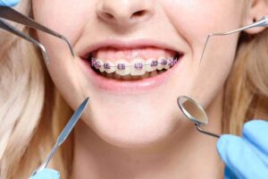تقويم الأسنان للأطفال مصر،أطباء تقويم أسنان متخصصين مصر،أفضل عيادة تقويم أسنان،مراكز تقويم معتمدة مصر،دكتور تقويم أسنان شاطر مصر،عيادة تقويم في القاهرة،مركز تقويم الأسنان في الجيزة،مراكز تقويم الأسنان في الإسكندرية،أفضل مركز تقويم أسنان في مدينة نصر،تقويم الأسنان في مصر الجديدة،أنواع تقويم الأسنان وأسعارها مصر،Invisalign مصر،تقويم الأسنان المعدني مصر،تقويم الأسنان الداخلي مصر،تركيب تقويم الأسنان مصر،أفضل دكاترة تقويم أسنان في مصر